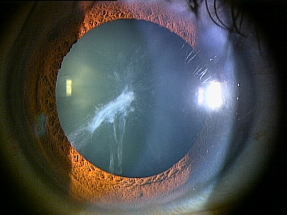 初期白内障の例