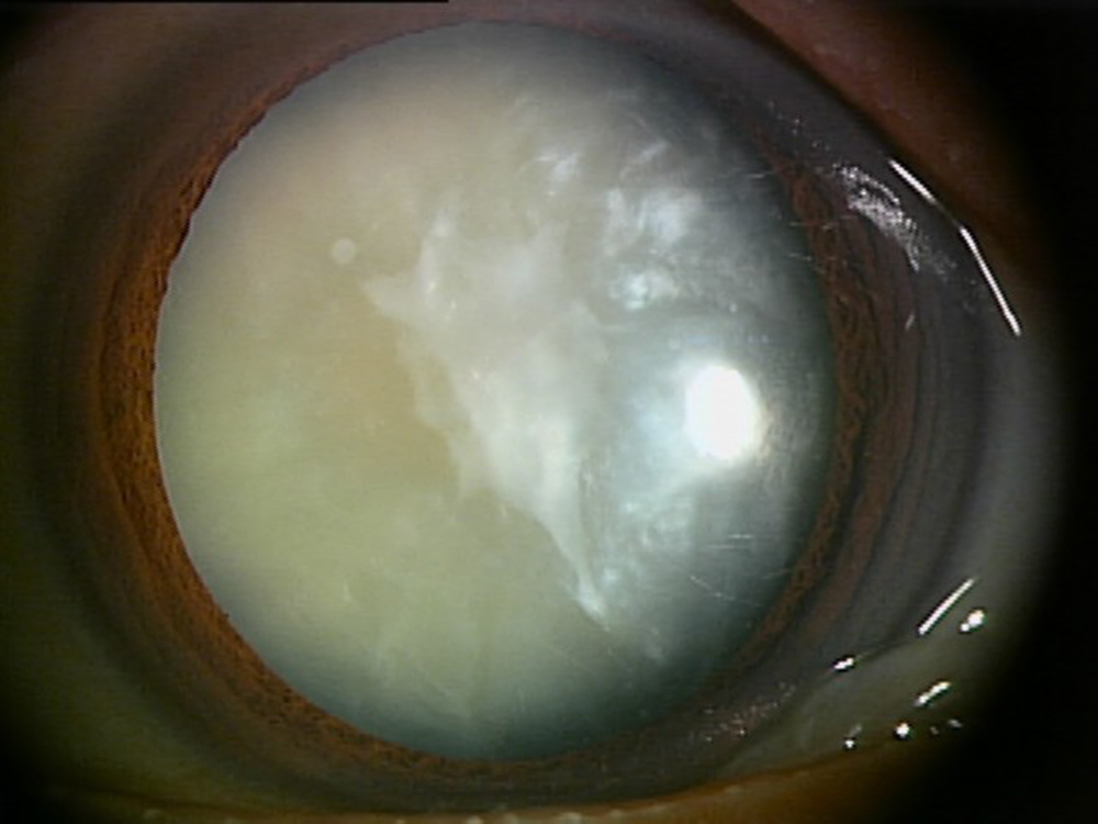 進行した白内障の例