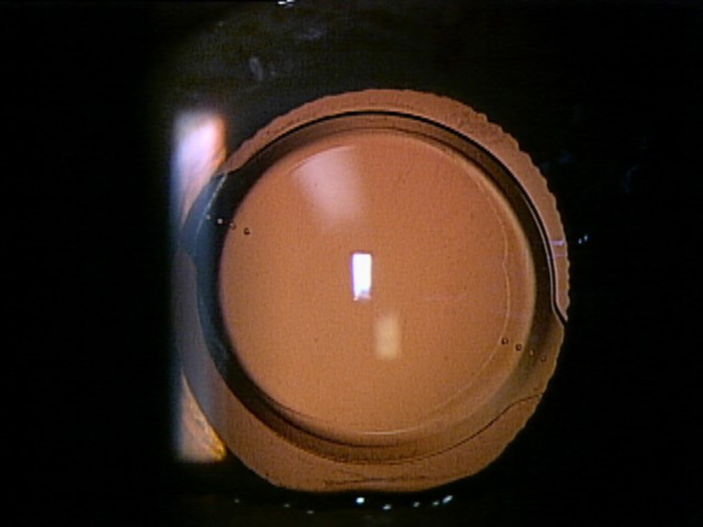 白内障の術後の例